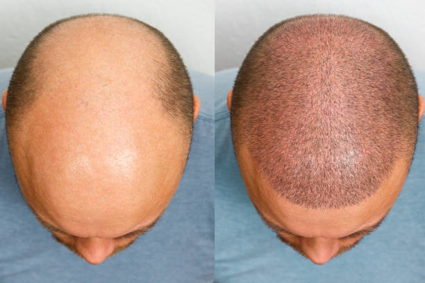 Hair Transplantation for Men