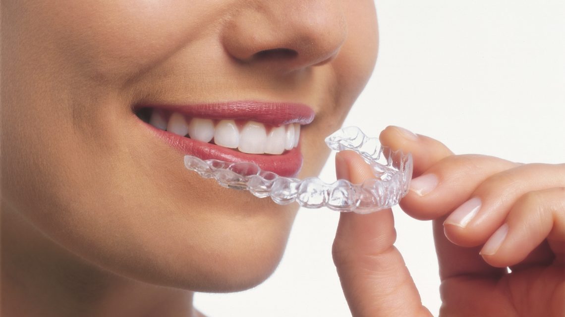 clear aligners singapore